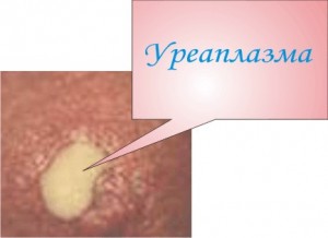 ᐈ Уреаплазмоз (уреаплазма): симптомы и лечение ~【Киев】